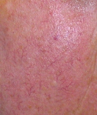 Laser vein treatment