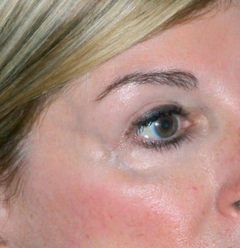 Laser vein removal