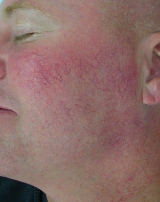Facial Vein Treatment