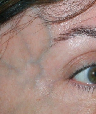 Laser Vein Removal 