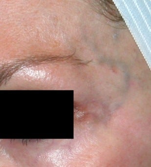 Laser facial vein treatment