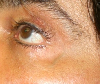 Laser Vein Treatment
