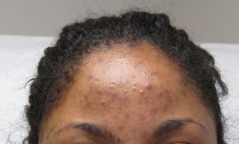 Vi Peel for acne and hyperpigmentation