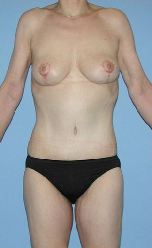 Complete Weight-Loss Makever (Body Lift, Breast Lift, Arm & Thigh Lift)