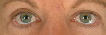 Botox for Wrinkle Treatment