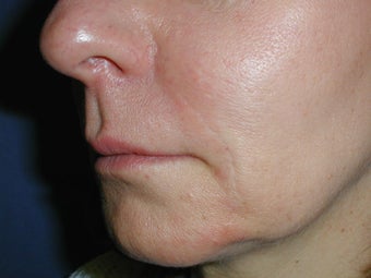 Radiesse for Nasolabial Folds