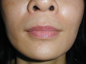 Radiesse in smile lines (Nasolabial Folds)