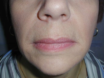 Restylane for smile lines (nasolabial folds)