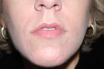 Nasal labial folds treatment with Evolence