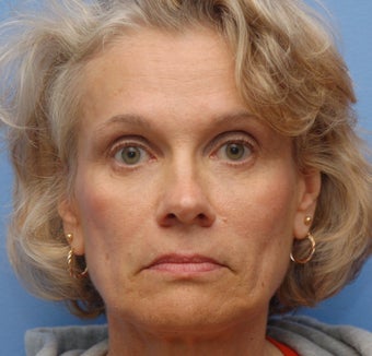 Liquid Facelift for Nasolabial Folds