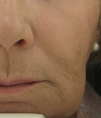 Radiesse for Nasolabial Folds and Marionette Lines