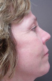 Wrinkle Removal