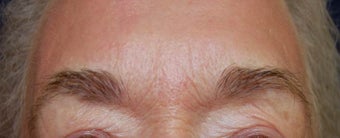 Total FX CO2 Laser