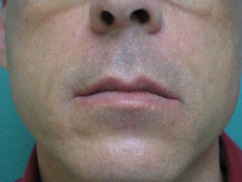 Radiesse for Nasolabial folds