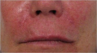 Juvederm to nasolabial folds