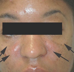 Treatment for Laugh lines