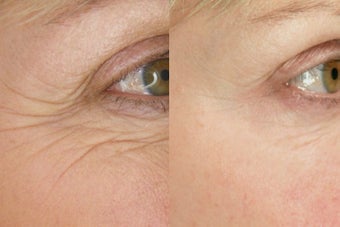 Botox for Wrinkle Treatment