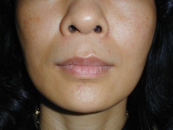 Radiesse in smile lines (Nasolabial Folds)