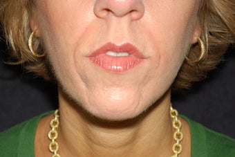 Nasal labial folds treatment with Evolence