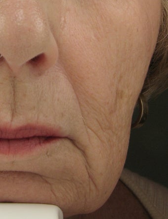 Radiesse for Nasolabial Folds and Marionette Lines