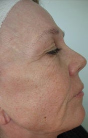 Wrinkle Removal