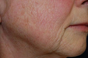 Total FX CO2 Laser