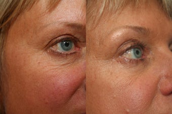 Non-Invasive Wrinkle Treatment