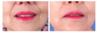 Restylane for nasolabial folds