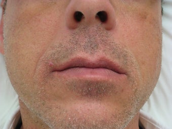 Radiesse for Nasolabial folds