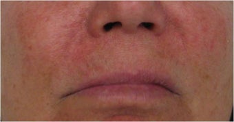 Juvederm to nasolabial folds