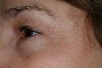 Crow's feet treatment