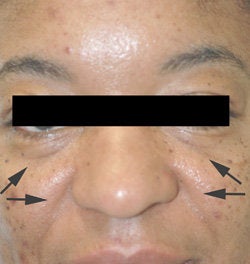 Treatment for Laugh lines