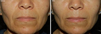 Fillers for Nasolabial Folds 