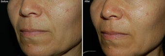 Fillers for Nasolabial Folds 