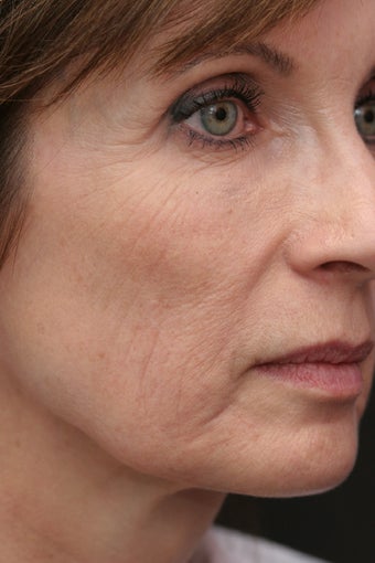 Micro Botulinum Toxin Injection