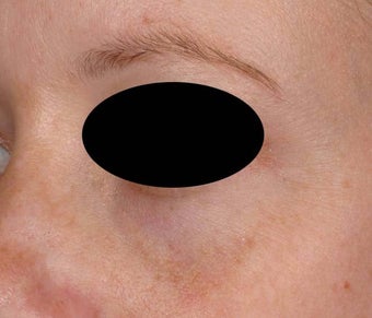 Bue veins under eyes