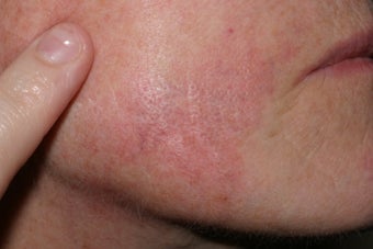 Yag laser