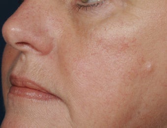 Yag laser