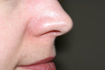 Yag laser