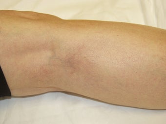 Laser vein removal on legs