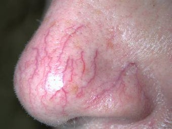 Vein treatment