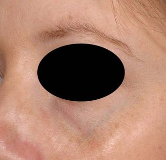 Bue veins under eyes