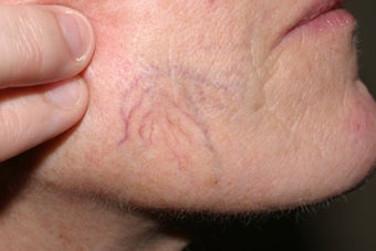 Yag laser