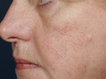 Yag laser