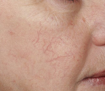 Yag laser