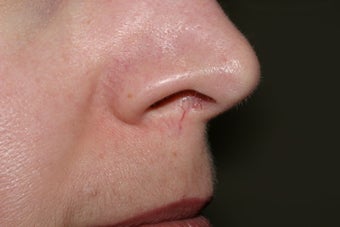 Yag laser