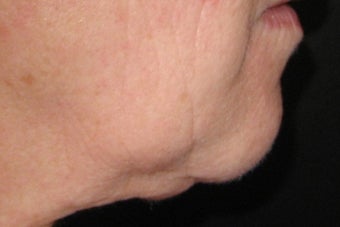 GentleYag treatment for skin tightening
