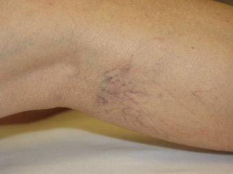Laser vein removal on legs