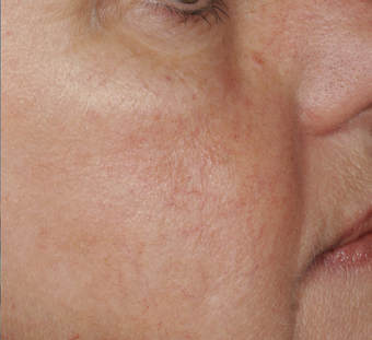 Yag laser