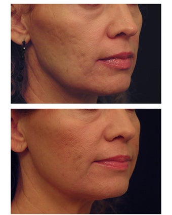 YAG Laser Skin Tightening
